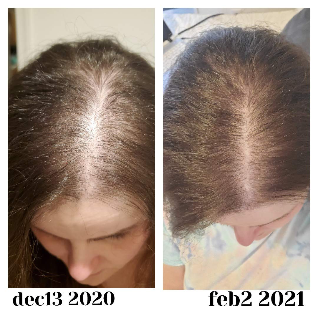 Baby Blues Postpartum Hair Loss Vitamins - Passion Fruit Gummies with Biotin, Collagen Baby Blues