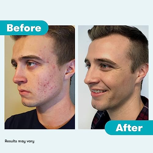 Proactiv 3 Step Acne Treatment - Benzoyl Peroxide Face Wash, Repairing Acne Spot Proactiv