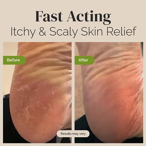 Tea Tree Oil Balm , Extra Strength, Pair Well with Jock Itch Cream, Spray, Athletes Foot Puriya