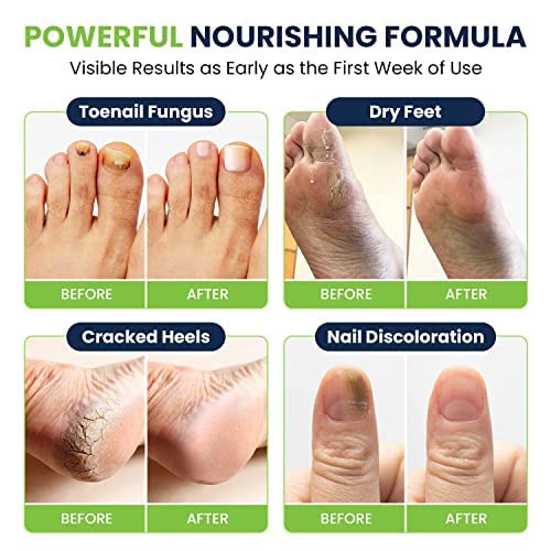 Toenail Fungus Treatment Extra Strength - Advance nail fungus treatment for fingernails FOOT CURE