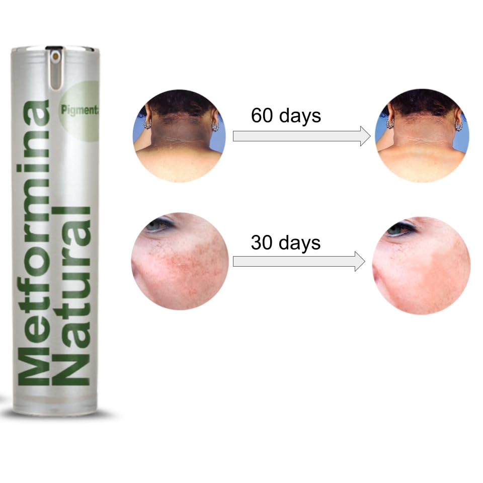 Ni una dieta más METFORMINA NATURAL - Cream for Dark Spots on Face and Body Ni una dieta más