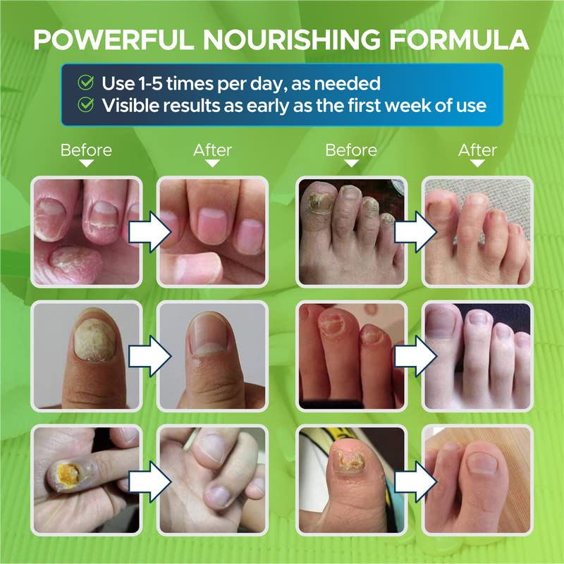 Toenail Fungus Treatment Extra Strength - Fungal Nail Treatment for Toe Nail & Fingernails FOOT CURE