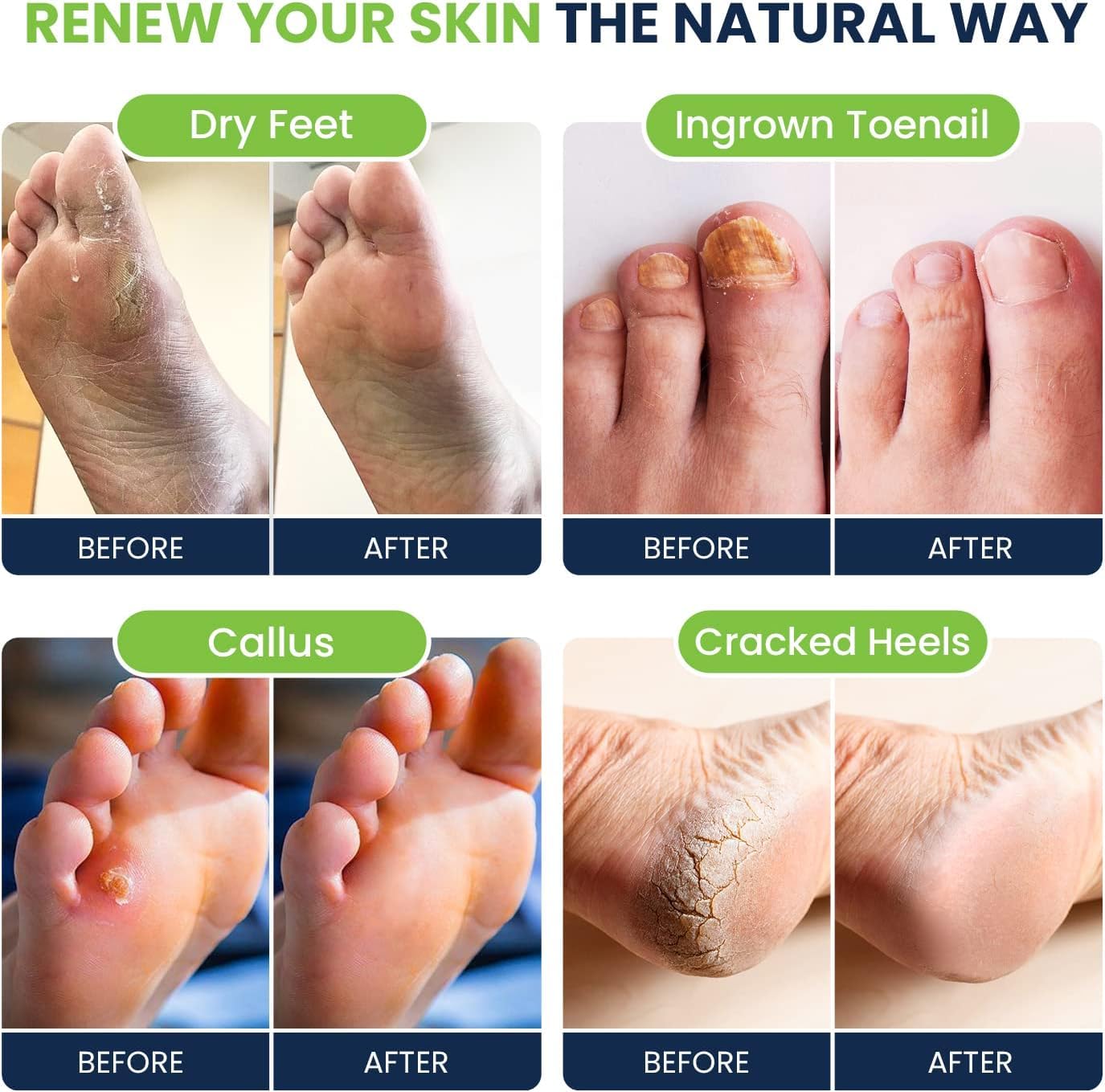 Tea Tree Oil & Citrus Detox Foot Soak with Epsom Salts - All Natural Salts for Post Workout FOOT CURE