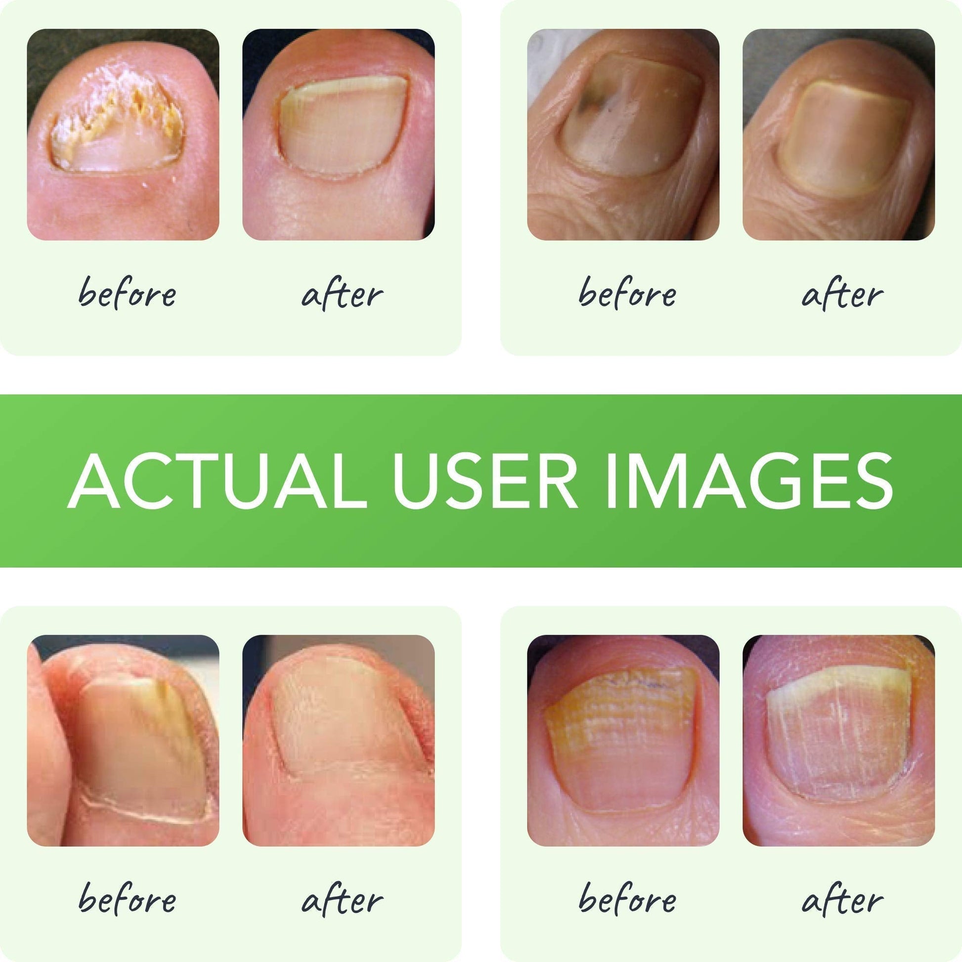 FUNGINIX Healthy Nail Formula - Finger And Toe Fungus Treatment, Made In USA, Foot FUNGINIX