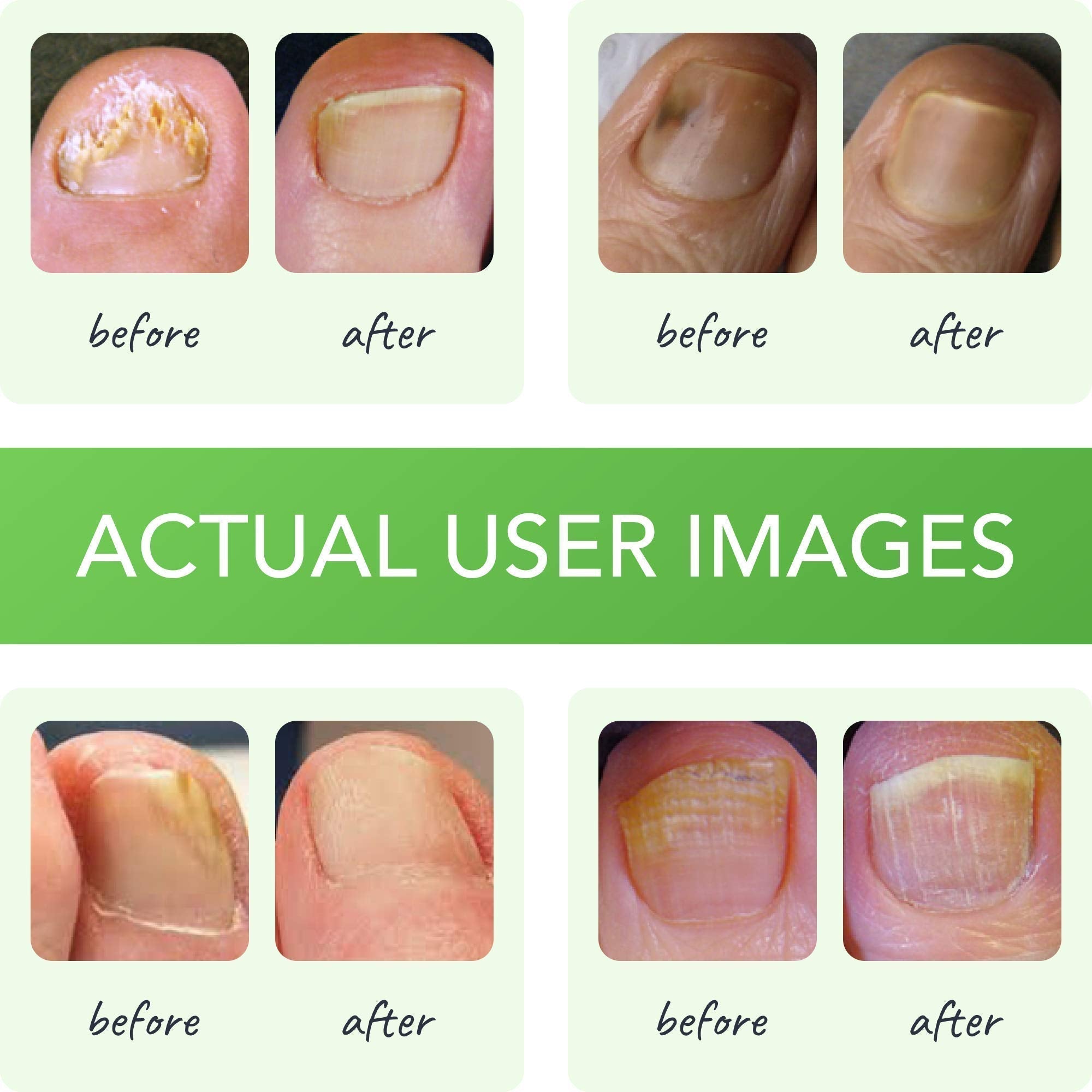 FUNGINIX Healthy Nail Formula - Finger And Toe Fungus Treatment, Made In USA, Foot FUNGINIX