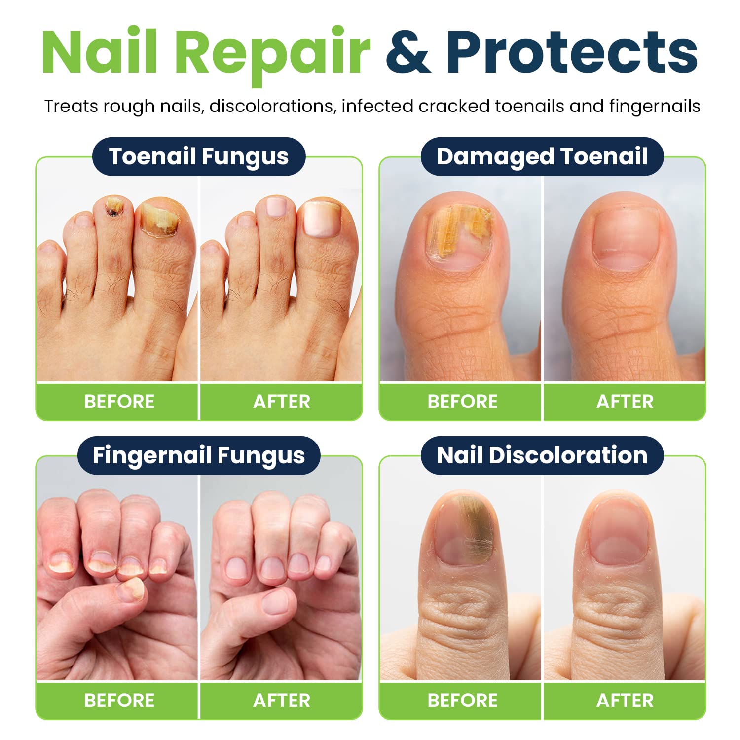 Toenail Fungus Treatment Extra Strength - Fungal Nail Treatment for Toe Nail & Fingernails FOOT CURE