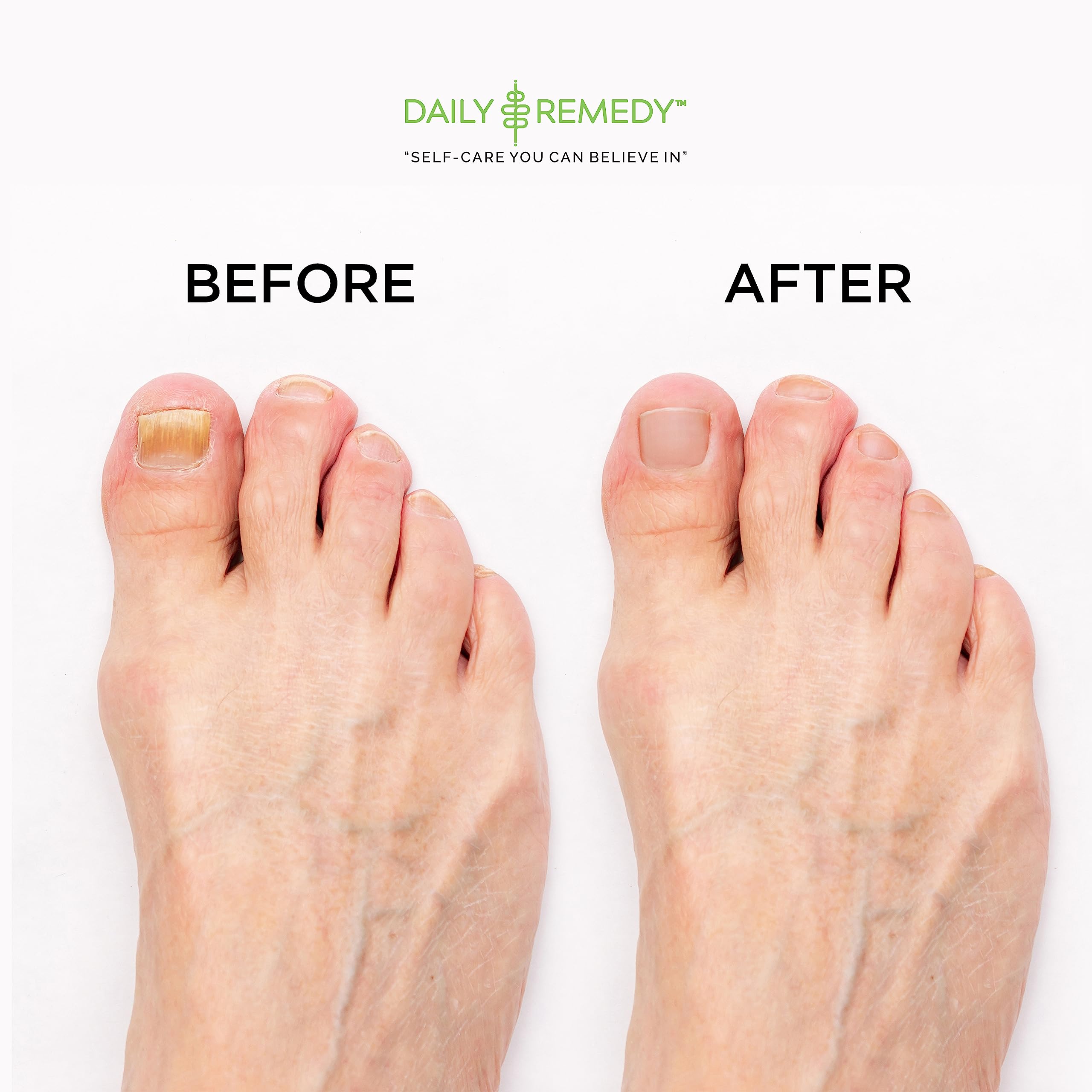 EXTRA STRENGTH Tea Tree Oil Foot Soak with Epsom Salt - Made in USA - for Toenails DAILY REMEDY